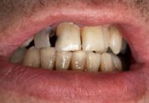 Prečo snívate o zhnitých zuboch Výklad snu: vypadol zhnitý zub